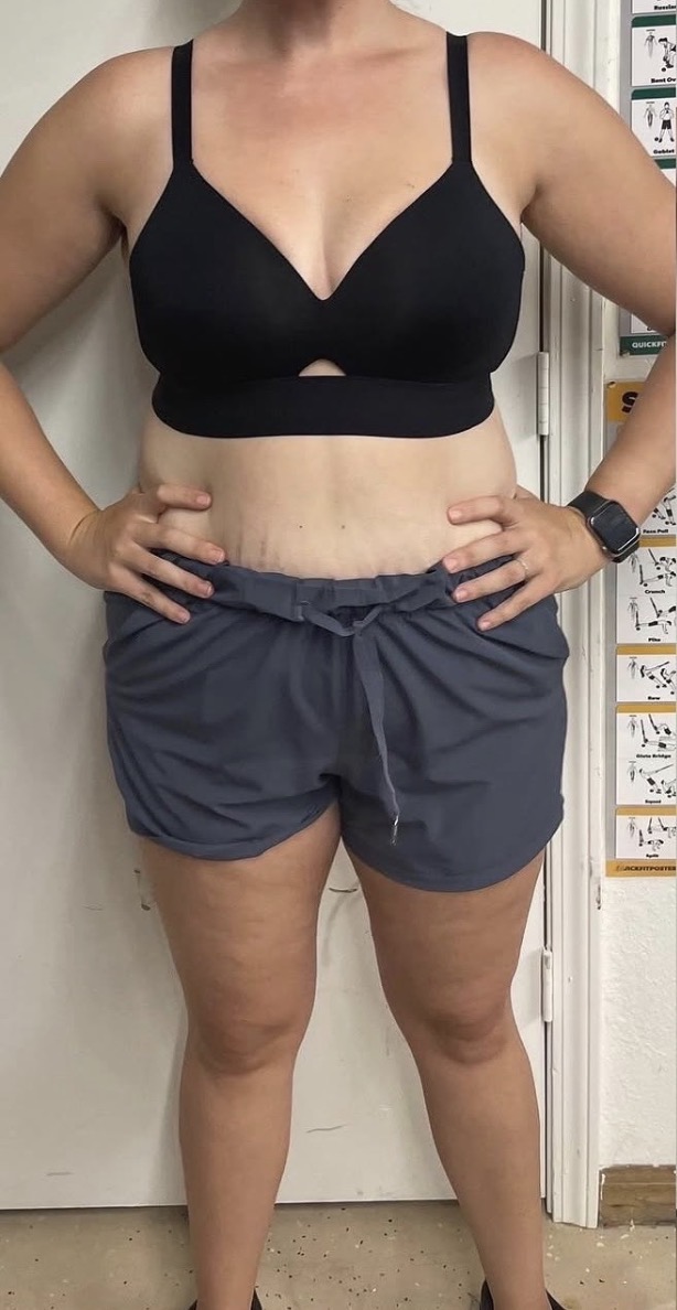 Patient 1 before photo